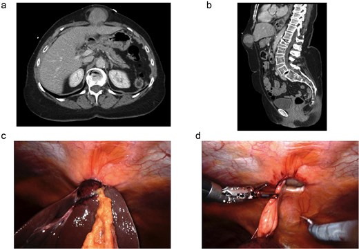 Four-panel figure showing imaging and operative findings of an incarcerated hepatic ventral incisional hernia. Axial and sagittal CT images demonstrate herniation of the left hepatic lobe through an anterior abdominal wall defect. Intraoperative robotic views show the incarcerated liver within the ventral hernia defect, followed by reduction of the herniated hepatic tissue and closure of the fascial defect during repair.
