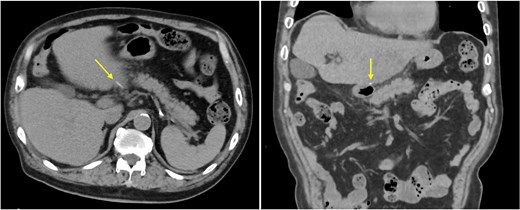 Axial and coronal CT images showing a linear high-density structure extending from the duodenum toward the liver, indicated by arrows.