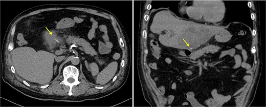 Axial and coronal CT images showing a linear high-density foreign body located further within the liver, with surrounding low-density inflammatory change, indicated by arrows.