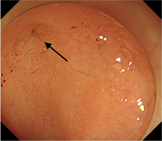Endoscopic image showing a small mucosal defect on the anterior wall of the duodenal bulb, indicated by an arrow.