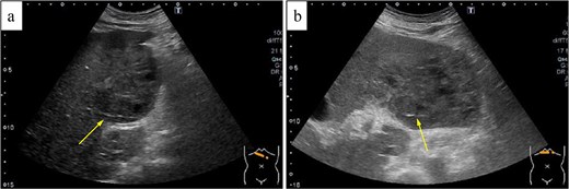 Two ultrasonography images showing a linear echogenic structure within the liver surrounded by a fluid collection, with enlargement of the abscess cavity between the initial examination and hospital Day 6.