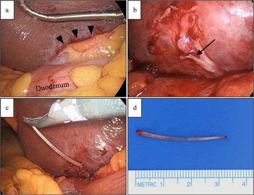 Intraoperative laparoscopic images showing dissection between the liver and duodenum, identification and removal of a fish bone from the liver, and the extracted fish bone specimen shown beside a measurement scale.