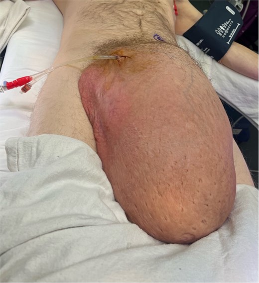 Clinical image of a patient lying supine with a large inguinoscrotal hernia extending toward the knee.