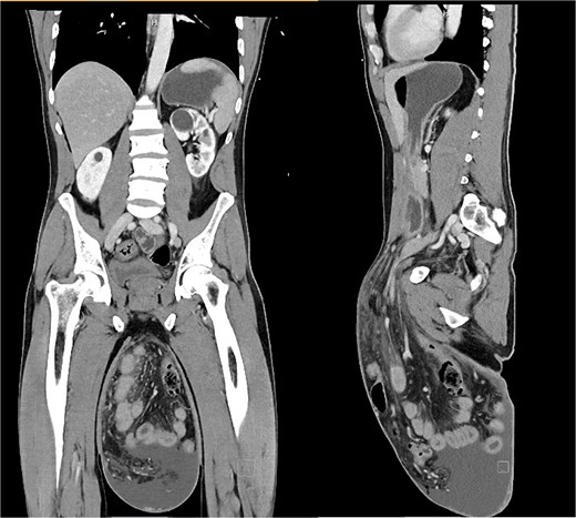 Computed tomography images showing abdominal contents herniating into a large inguinoscrotal sac without obstruction.