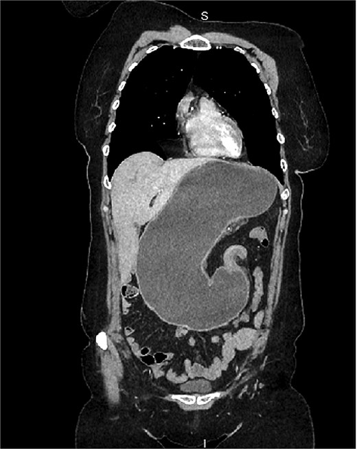 Contrast-enhanced CT demonstrated a markedly distended stomach with abnormal orientation consistent with organoaxial gastric volvulus.