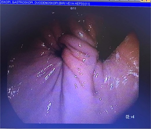 Endoscopic view demonstrating twisted gastric folds and distorted lumen consistent with gastric volvulus.