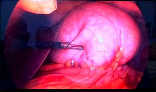 Laparoscopic view of organoaxial gastric volvulus.