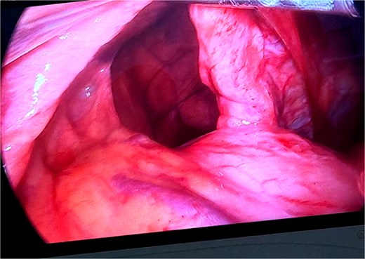 Intraoperative image showing the hiatal defect and herniation of the stomach into the thoracic cavity.