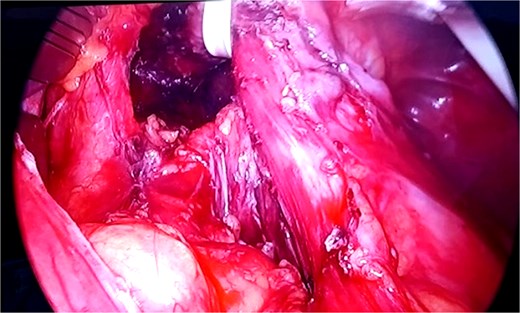 Dissection of the hiatus and preparation for hiatal repair.