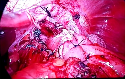 Completed cruroplasty and Nissen fundoplication after reduction of the volvulus.