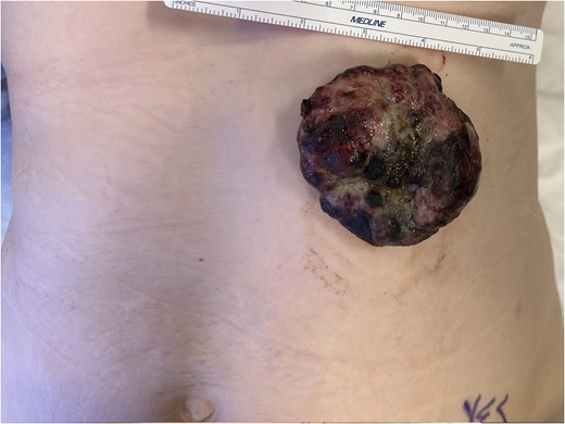 Clinical photograph of the left anterior chest wall showing a large exophytic fungating mass protruding from the skin surface.
