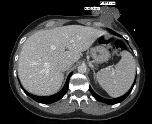 Axial contrast-enhanced CT image of the chest showing a well-defined soft tissue mass arising from the left anterior chest wall and projecting outward from the subcutaneous tissues without obvious extension into the thoracic cavity.