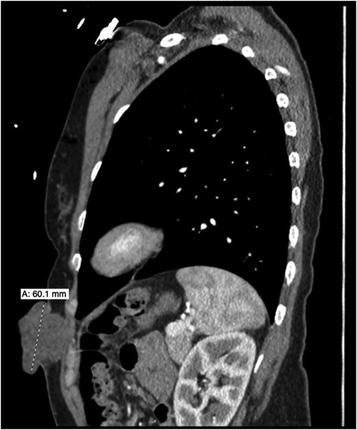 Sagittal contrast-enhanced CT image of the chest showing a large exophytic soft tissue mass arising from the left anterior chest wall and extending outward from the subcutaneous tissues without obvious invasion of the thoracic cavity.