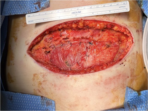 Intraoperative photograph showing a large elliptical surgical defect of the left anterior chest wall following excision of a soft tissue mass, with exposed underlying fascia visible within the wound bed.