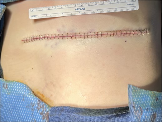Intraoperative photograph showing a linear closed incision on the left anterior chest wall following primary closure of a surgical defect after mass excision.