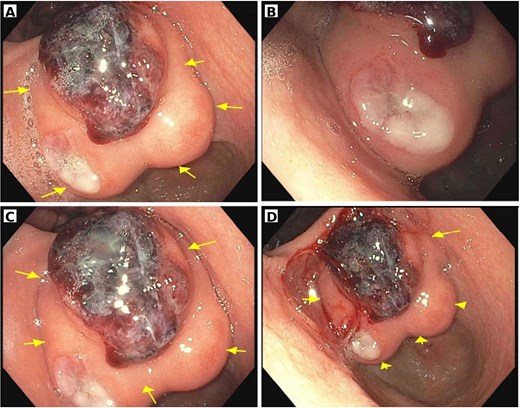 Four endoscopic images of the stomach showing a large, lobulated gastric mass with ulcerated, necrotic surface and an area of active mucosal bleeding.
