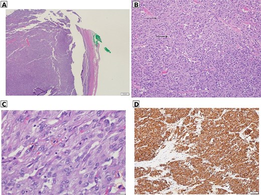 Four histopathology images of resected gastric tissue showing tumor cells under low, medium, and high magnification, plus a positive CD117 immunostain.