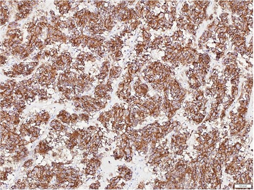 Microscopic image of tumor tissue showing positive DOG1 immunohistochemical staining.