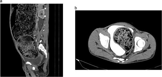 CT-abdomen findings showing massive dilation of transverse, descending and sigmoid colon with stool filled cavity.