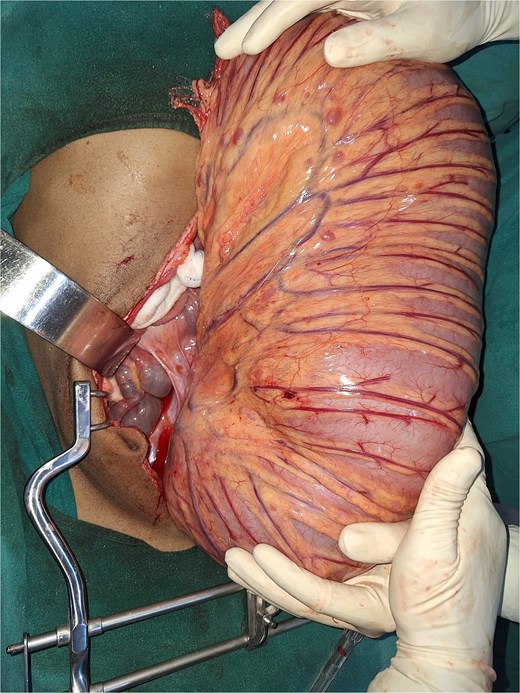 A abdominal incision wound through which a large bowel segment has been brought out showing massive dilation of the colon. Multiple hands are holding the colon.