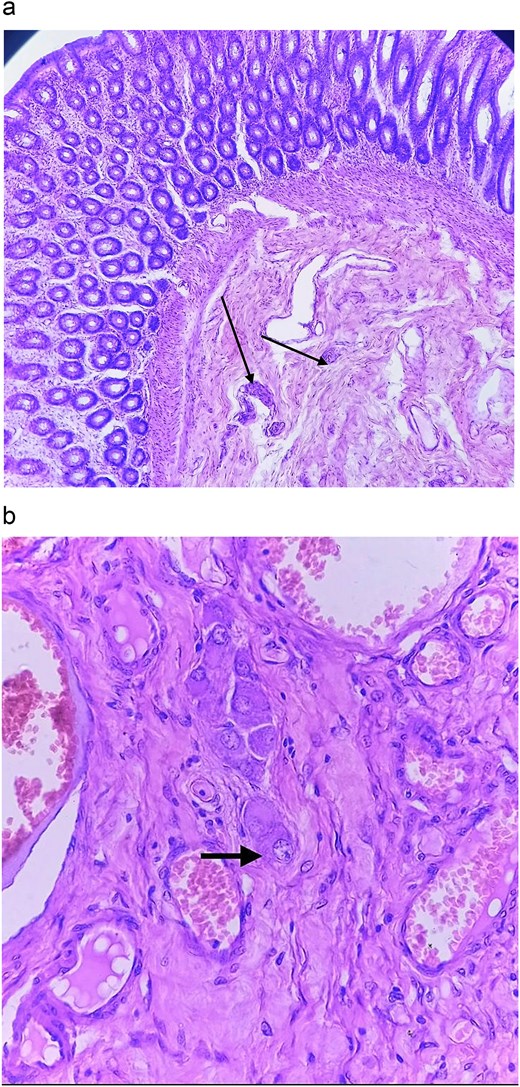 Histopathological findings of the colon with one showing the absence of ganglionic cells at the affected colon portion while the other showing presence of ganglionic cells at the healthy colon segment.