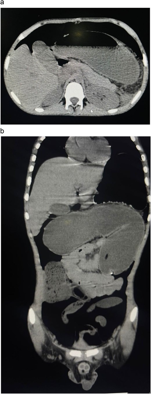 CT-abdomen findings showing the presence of dilation of remaining portion of large intestine and bowel with air fluid levels with a transition point at the stoma.