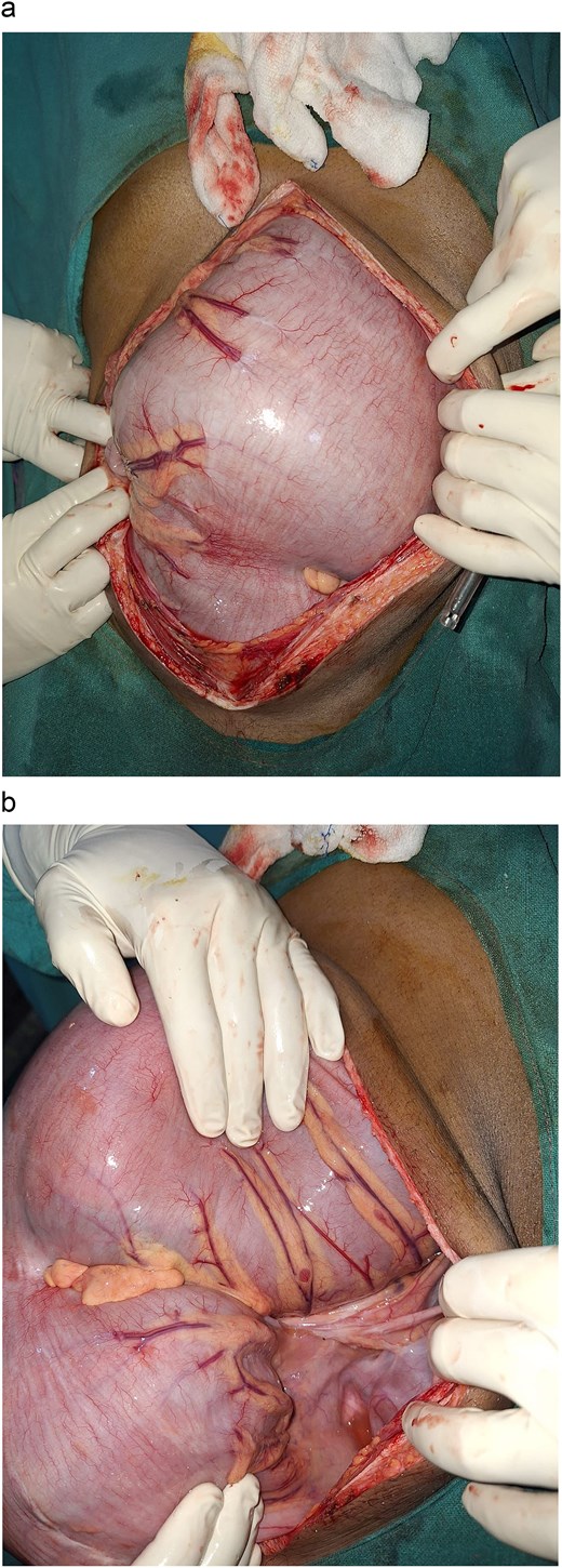 An abdominal incision through which a massively dilated colon is brought out. Multiple hands are holding the colon.