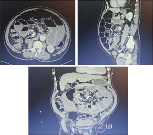 Axial, sagittal, and coronal CT scan views of the abdomen showing severely dilated loops of the small bowel with fluid levels and a distinct twisting pattern of the mesenteric vasculature in the center.