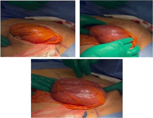 Intraoperative clinical photographs showing an open laparotomy where the small intestines are compactly clustered together and completely enclosed within a thick, yellowish-white fibrous capsule resembling a cocoon.