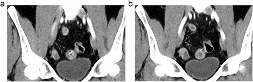 (a, b) Selected coronal images of A-CT post contrast show a dense linear foreign body (red arrows) within the distal ileal loops with pointed end of the linear structure noted possibly penetrating through the small bowel wall protruding to the peritoneal cavity with associated local bowel wall thickening with submucosal edema and mucosal hyperemia. No evidence of adjacent free fluid or free air. No significant surrounding fat stranding.