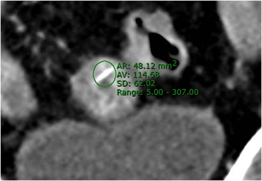 Selected A-CT coronal image showing the linear foreign body with ROI (region of interest) measurement of maximum density of the structure reaching 307 HU and also no streaking artefact is seen. These features indicate that the structure is of moderate density and non-metal material.