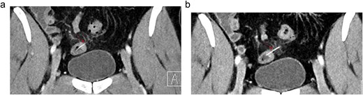 (a, b) Selected coronal images of A-CT with contrast done as follow up after 24 hours showing again the foreign body (arrows) penetrating the bowel wall and partially extending into the mesentery with development of surrounding mesenteric fat strand. No free air or fluid collection.