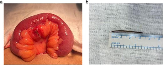 (a, b) Showing the mesenteric border penetration of the terminal ileal segment with abnormal mesentery, and the foreign body retrieved and measured 3 cm.
