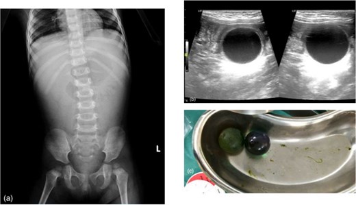 Abdominal radiograph showing small bowel dilatation, ultrasound demonstrating two round anechoic intraluminal lesions, and intraoperative image showing two expanded water-absorbing beads causing intestinal obstruction.