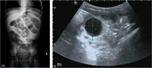 Abdominal radiograph demonstrating dilated bowel loops and ultrasound image showing a round cystic intraluminal lesion consistent with an expanded water-absorbing bead.