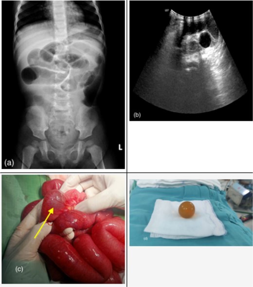 Imaging and operative findings of small bowel obstruction caused by a water-absorbing bead, including ultrasound appearance, intraoperative localization, and the extracted bead specimen.