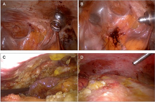 Composite intraoperative laparoscopic images showing extensive intra-abdominal adhesions and diffuse peritoneal carcinomatosis during repeated PIPAC, with successful Capnopen positioning.