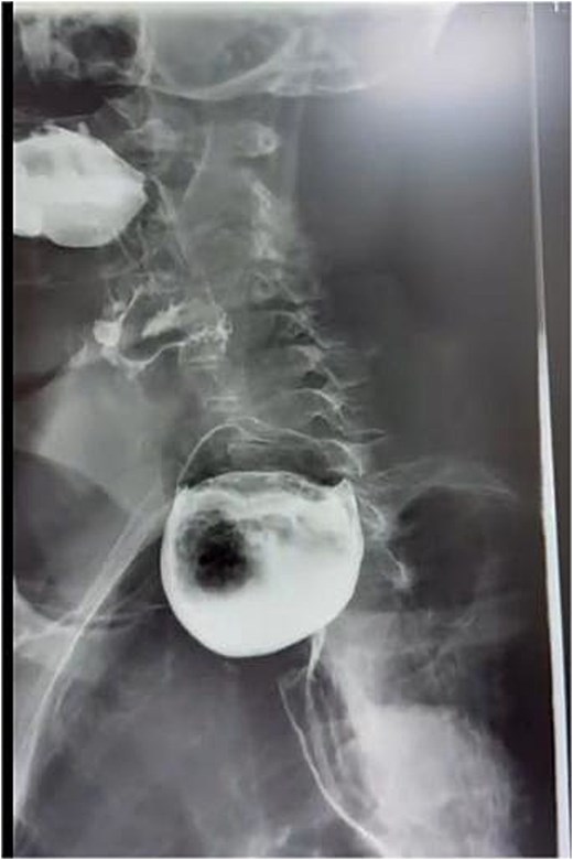 Lateral barium swallow radiograph showing a contrast-filled outpouching arising posteriorly from the pharyngoesophageal junction with an air-fluid level.