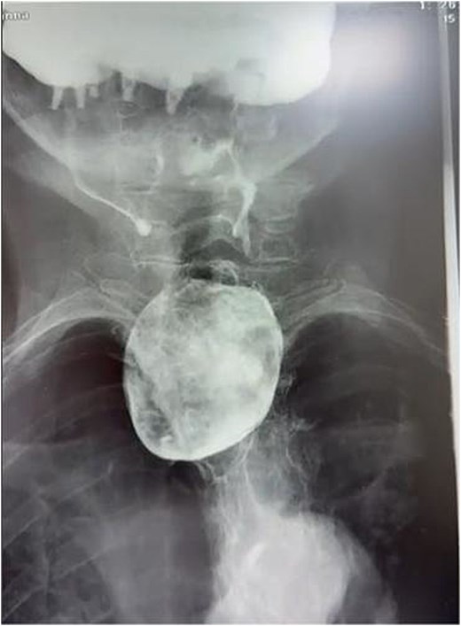 Anteroposterior barium swallow radiograph showing a large contrast-filled pouch arising from the proximal esophagus at the level of the thoracic inlet.