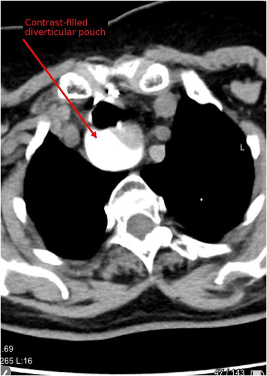 Axial contrast-enhanced CT image showing a contrast-filled posterior outpouching arising from the pharyngoesophageal region.
