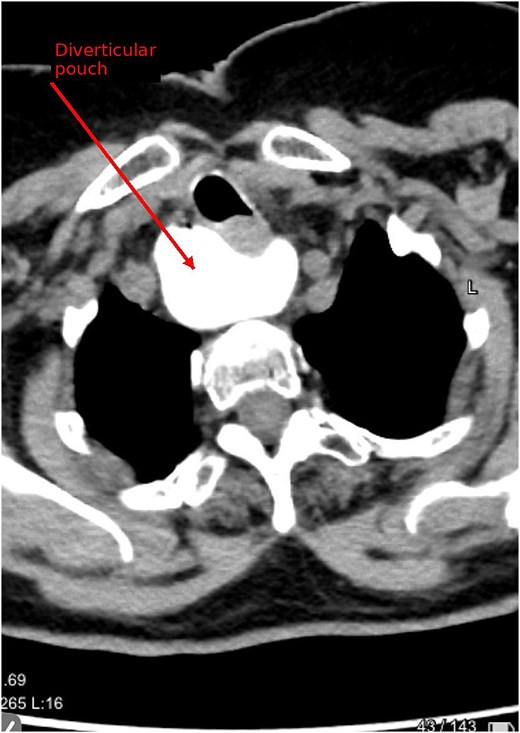 Axial contrast-enhanced CT image showing a diverticular pouch located at the level of the thoracic inlet.