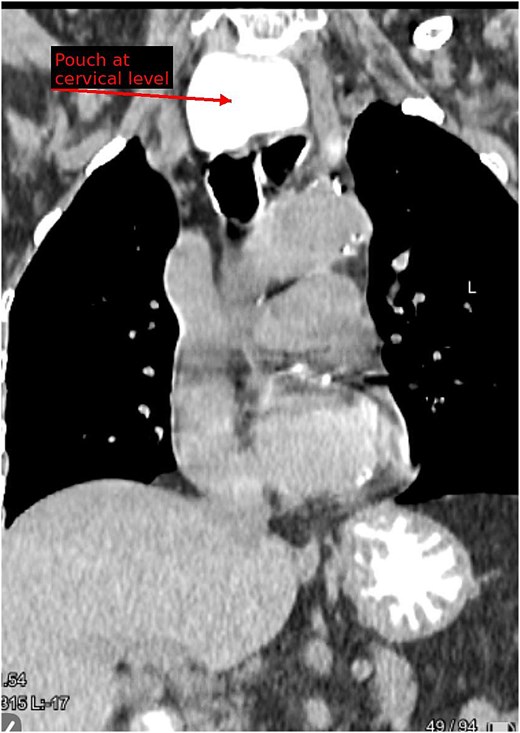 Coronal contrast-enhanced CT reconstruction showing a cervical diverticular pouch and its extension along the craniocaudal axis.