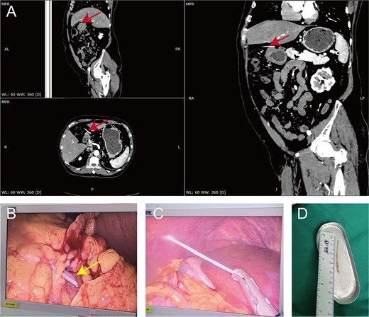 Preoperative CT, intraoperative findings, laparoscopic retrieval, and postoperative measurement of the fish bone in Case 1.