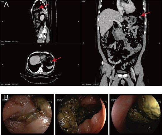 Preoperative CT showing a suspected linear hyperdense foreign body and postoperative colonoscopy showing no residual foreign body in Case 2.