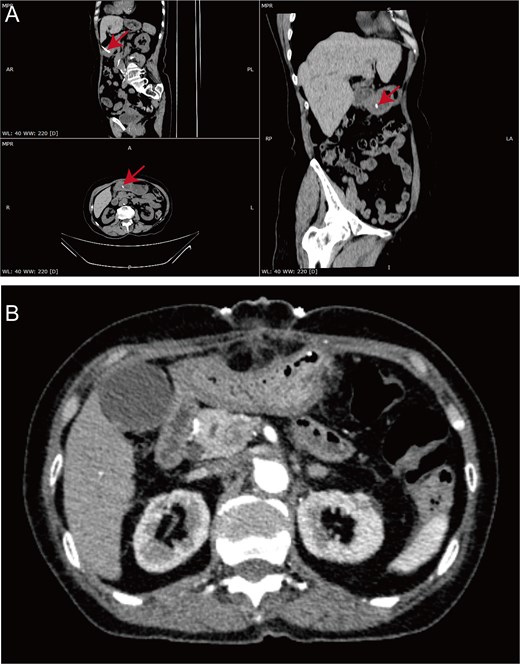 Preoperative CT showing a linear hyperdense shadow and postoperative CT showing resolution of the suspected lesion in Case 3.