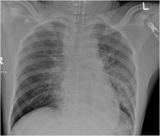 Initial chest X-ray showing widen mediastinum.