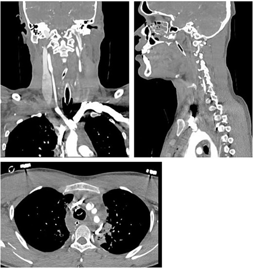 Initial CT scan showing IA flap with tiny extravasation of the contrast.