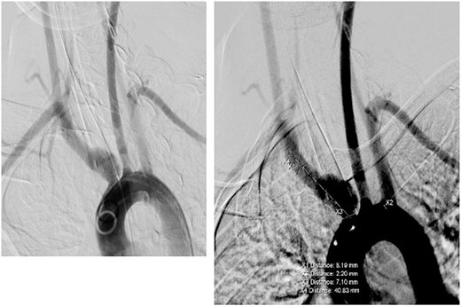 Angiogram showing IA aneurysm.