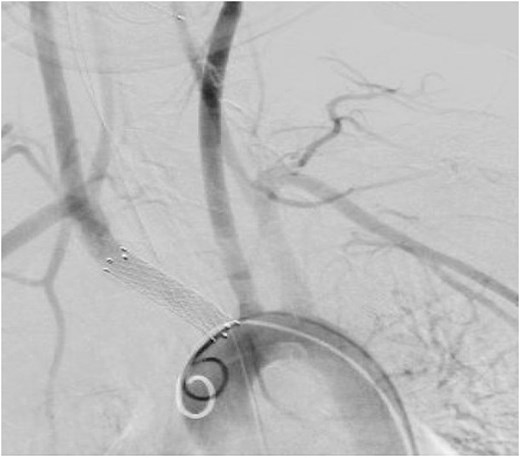 Angiogram post endovascular stenting.