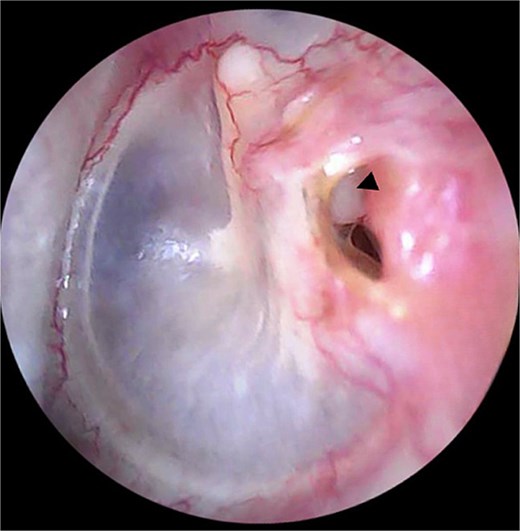 Otoscopic examination showing a small perforation in the posterosuperior quadrant of the left tympanic membrane. The long process of the incus (arrow head) is visible through the perforation.